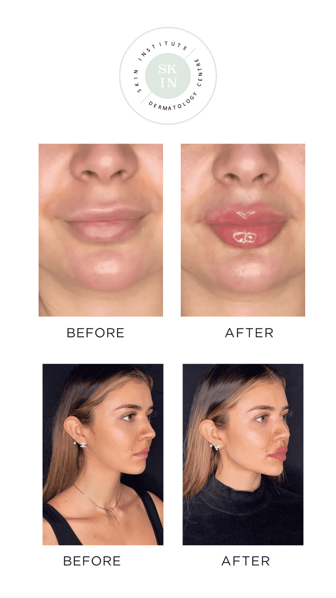 Best Lip Fillers Abudhabi | Skin Institute Dermatology Centre