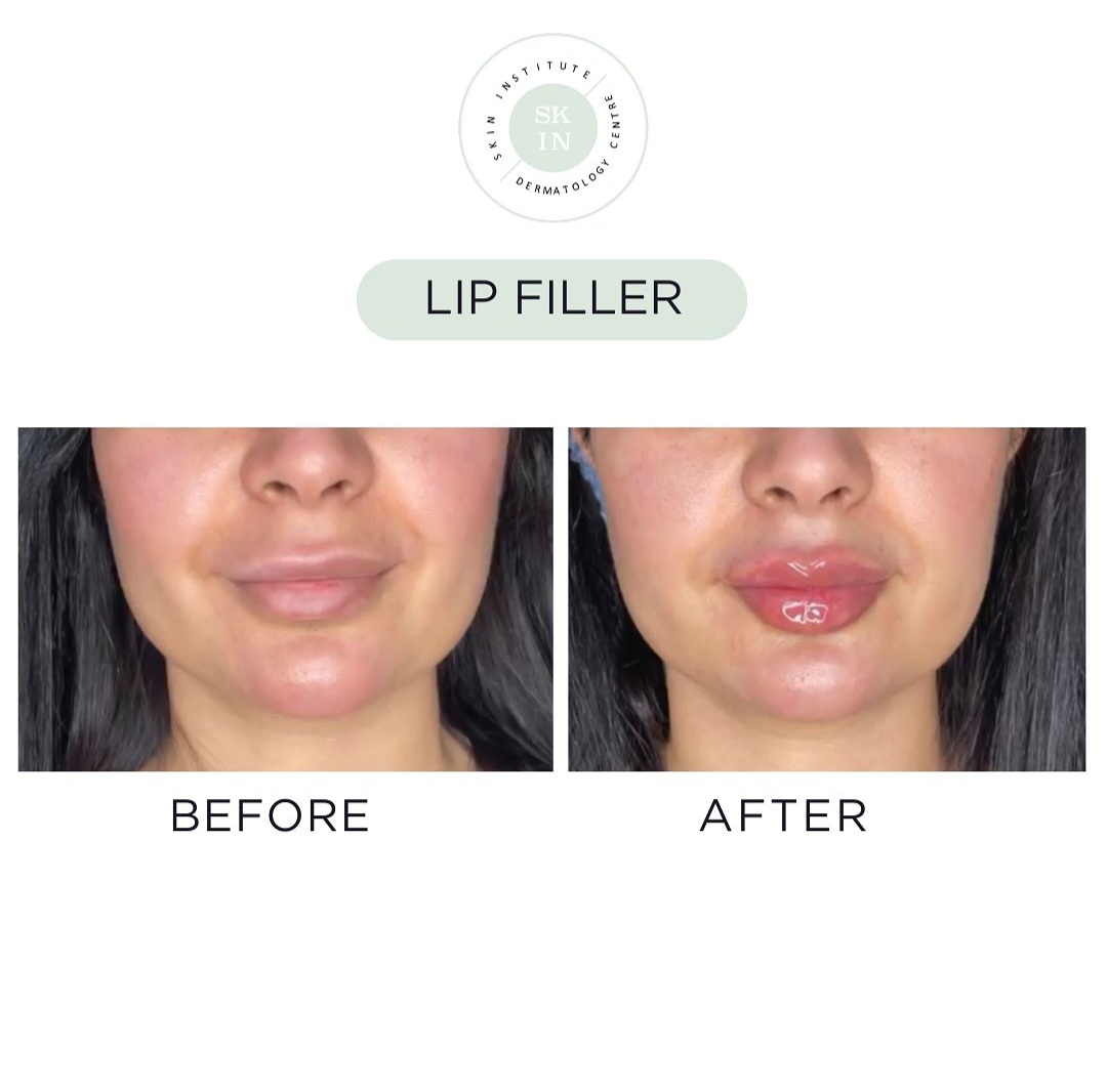 Top-Rated Lip Filler Treatments Available in Abu Dhabi