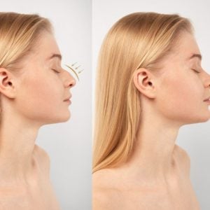 Nasal-bridge-and-tip-refinement-with-rhinoplasty-rqww58ye0s7lthe5j3nlr65vxzu2grwk2irnimzans1788159285